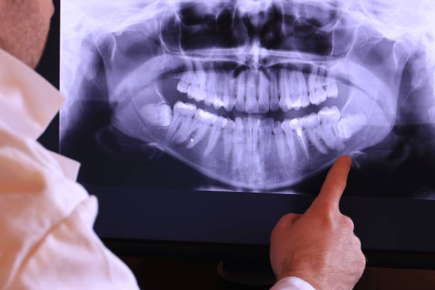Best Emergency Wisdom Teeth Removal in Nambe, NM